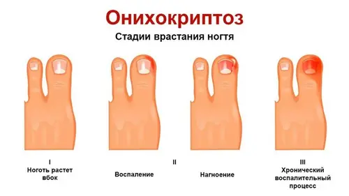 Onychocryptosis stadier af neglens indvækst