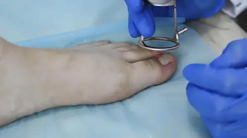 fjernelse af nedgroet tånegl